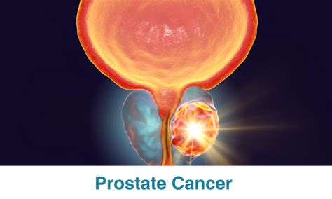Kanser sa Prostate (Prostate Cancer) .